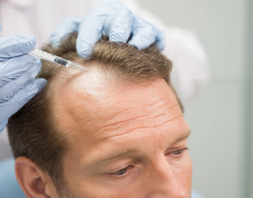 hair transplant in hamburg